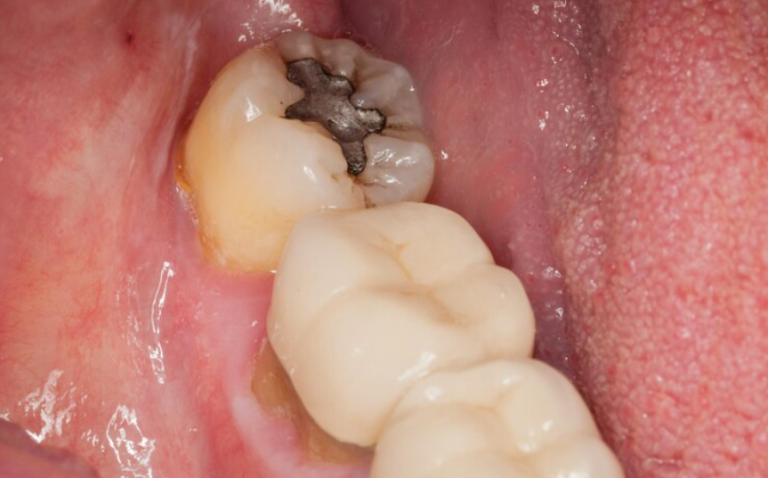 How Can Dentists Identify Hidden Cavities That Are Not Visible