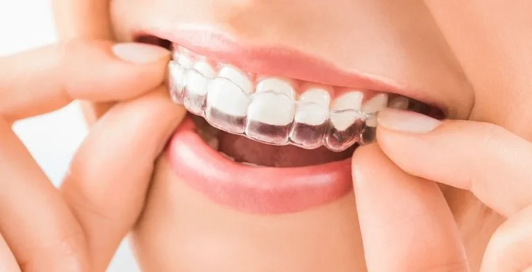 Discover Essential Invisalign Treatment Facts Before Choosing Experienced Dental Professionals in Surrey 