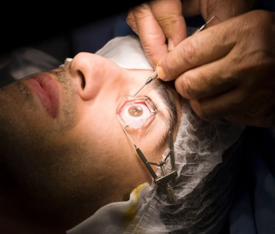 Understanding the Difference Between LASIK, SMILE, and Lens Replacement Surgery